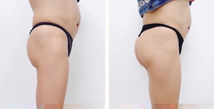 buttock-implant-image