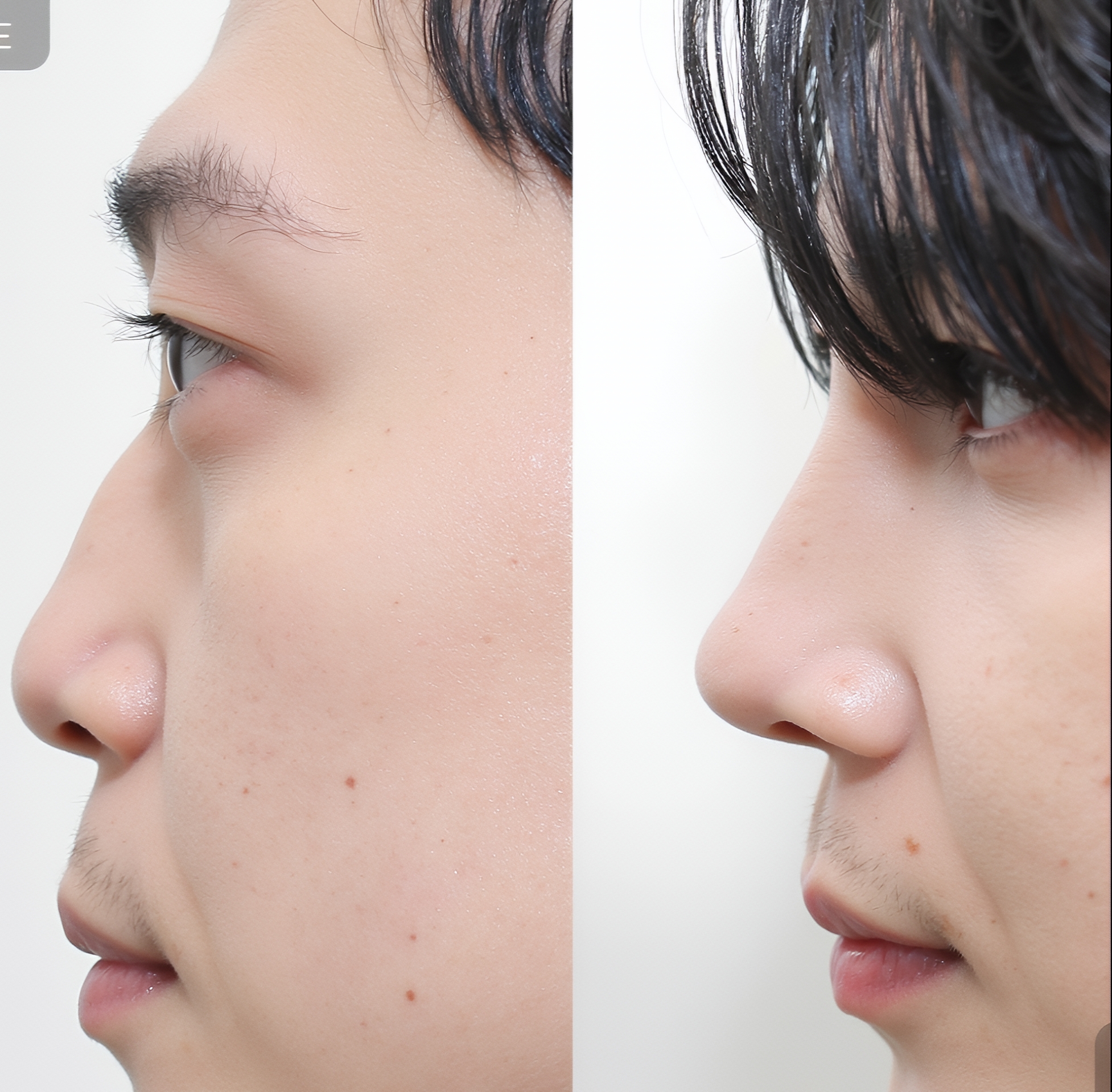 콧대 성형