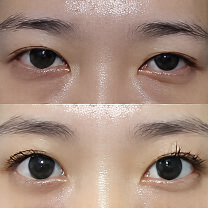 안검하수 교정