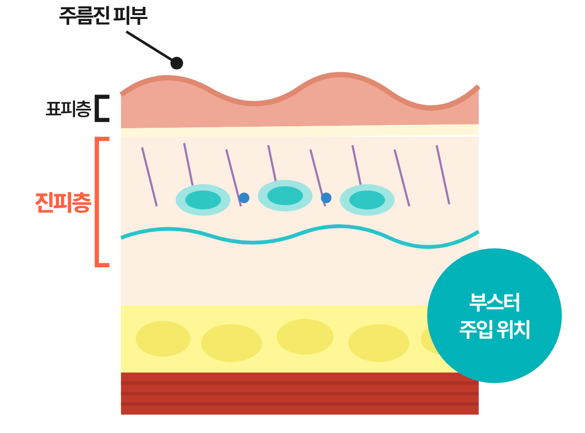 진피층에 스킨부스터를 주입하는 과정을 나타낸 의학 일러스트